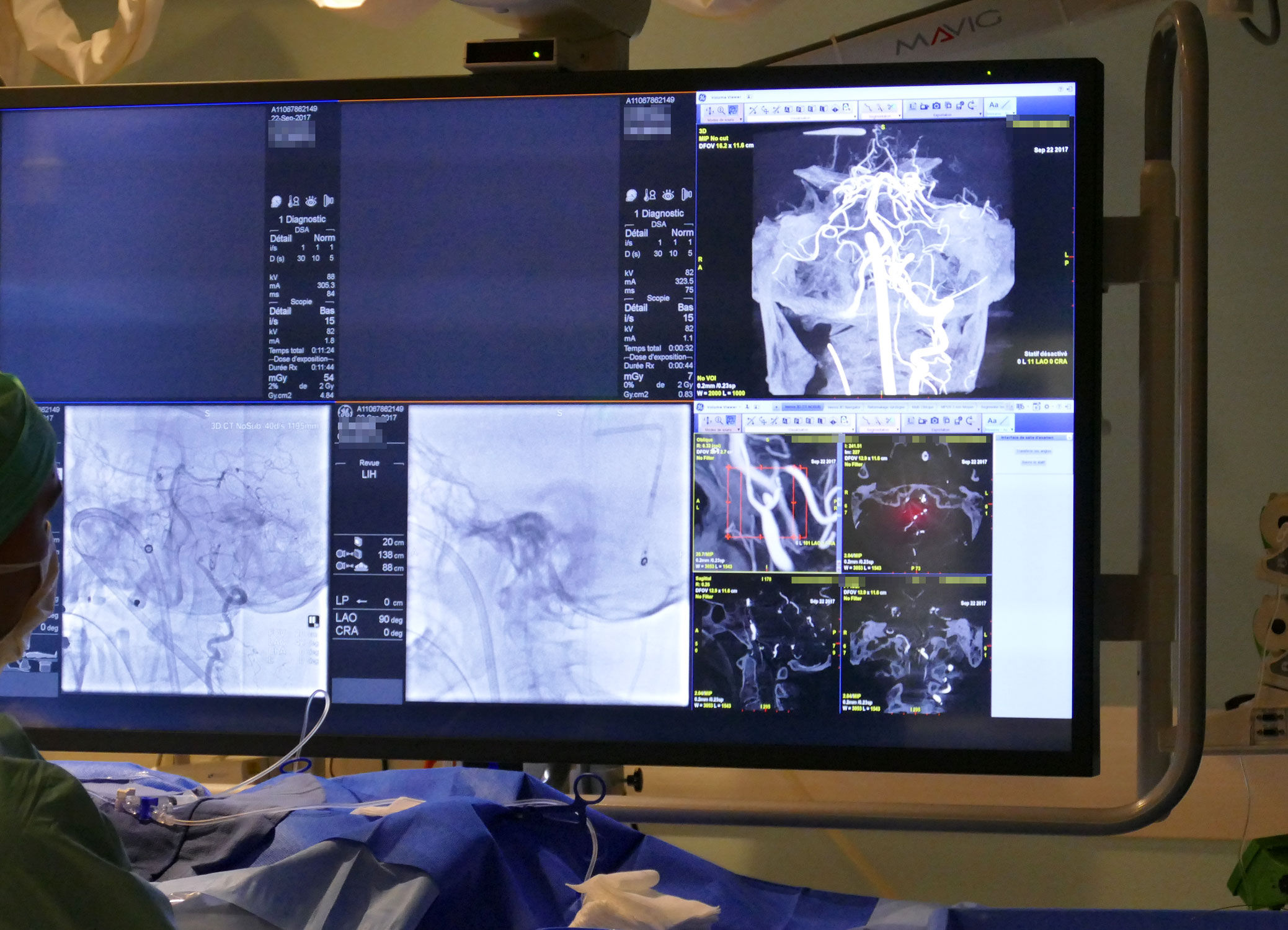 neuroradiologie CHRUNANCY salle 02