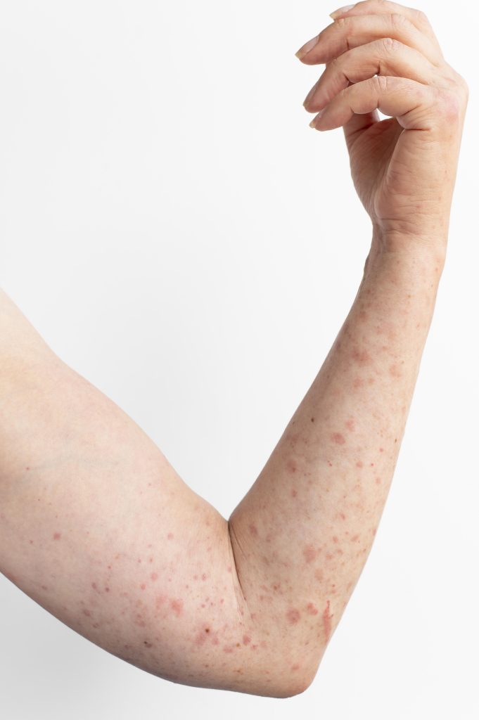 allergie sur l'avant-bras