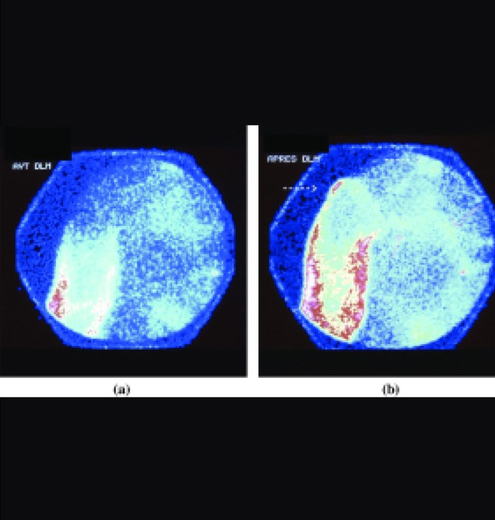 Lymphoscintigraphie des membres