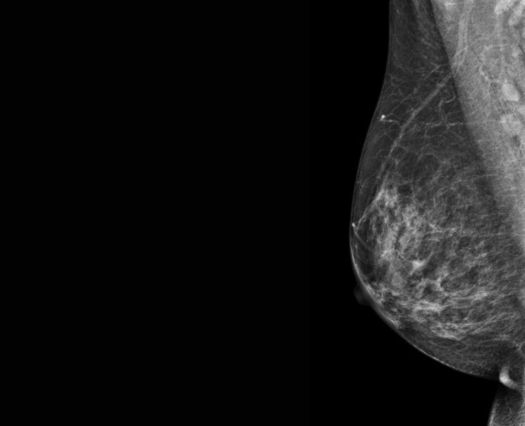 Vision d'une mammographie oblique