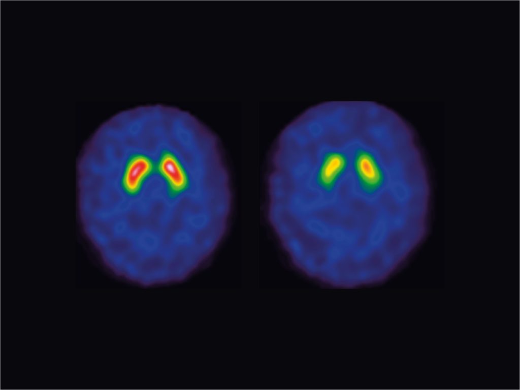 Scintigraphie cérébrale au Datscan