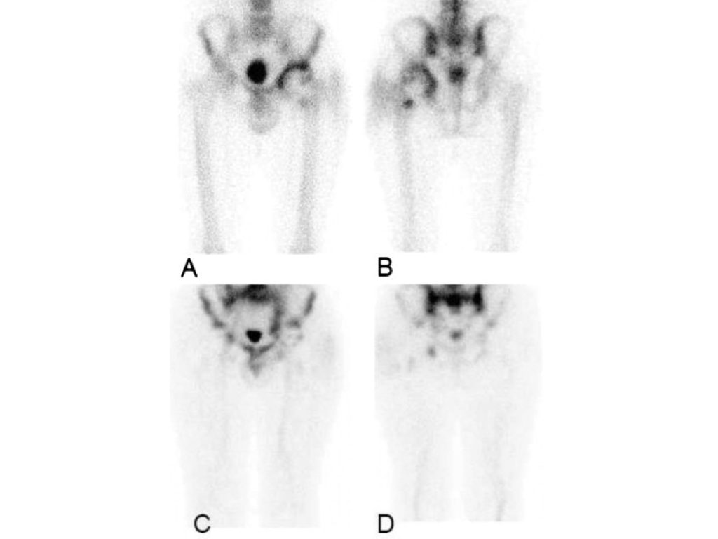 Scintigraphie aux leucocytes marqués