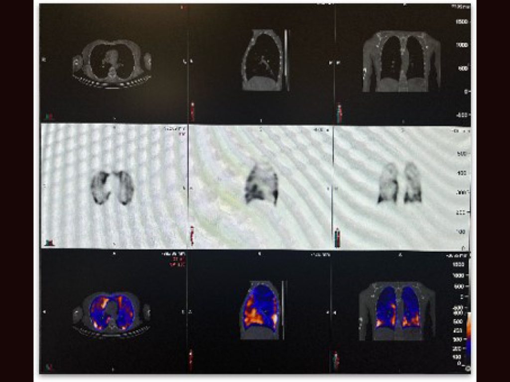Scintigraphie pulmonaire