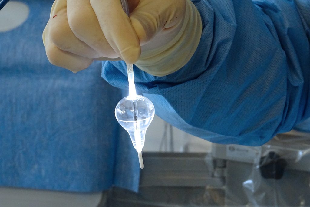 ablation de fibrillation atriale