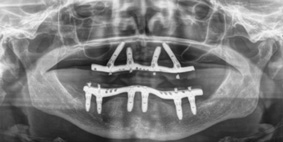 radio d'implant dentaire