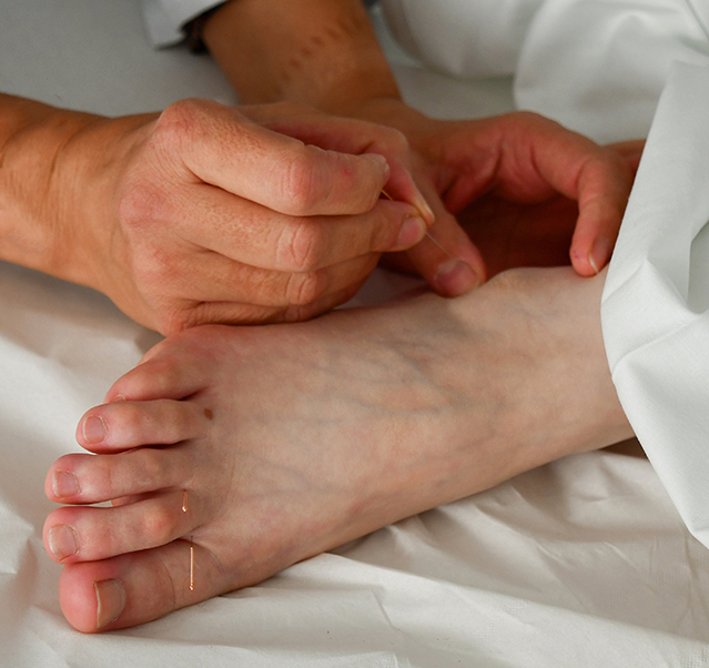 Aiguilles d'acupuncture
