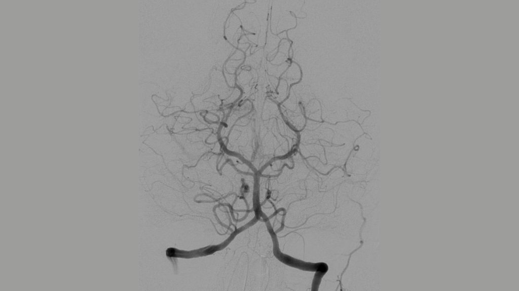 Angiographie cérébrale