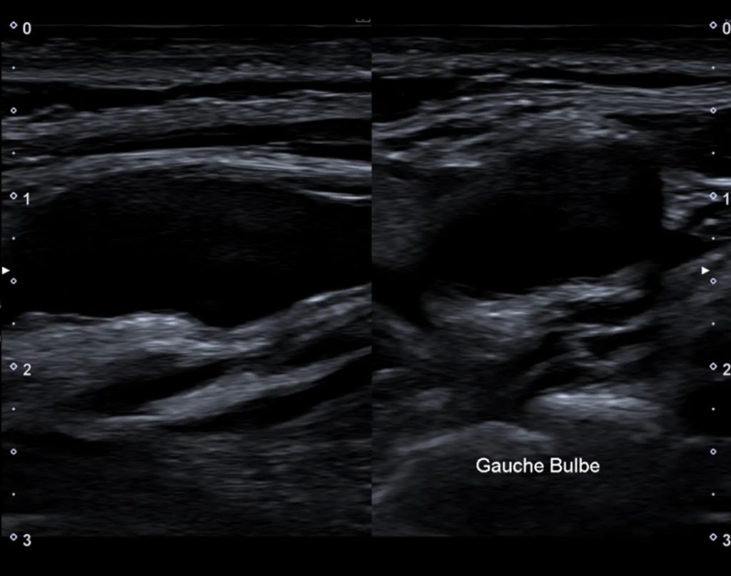 Echo-Doppler Artériel des troncs supra-aortiques
