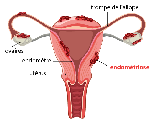 schéma expliquant l'endométriose