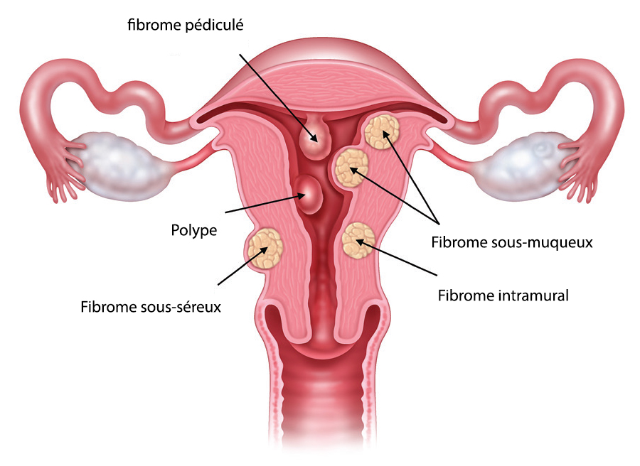 Schéma montrant des fibromes et des polypes