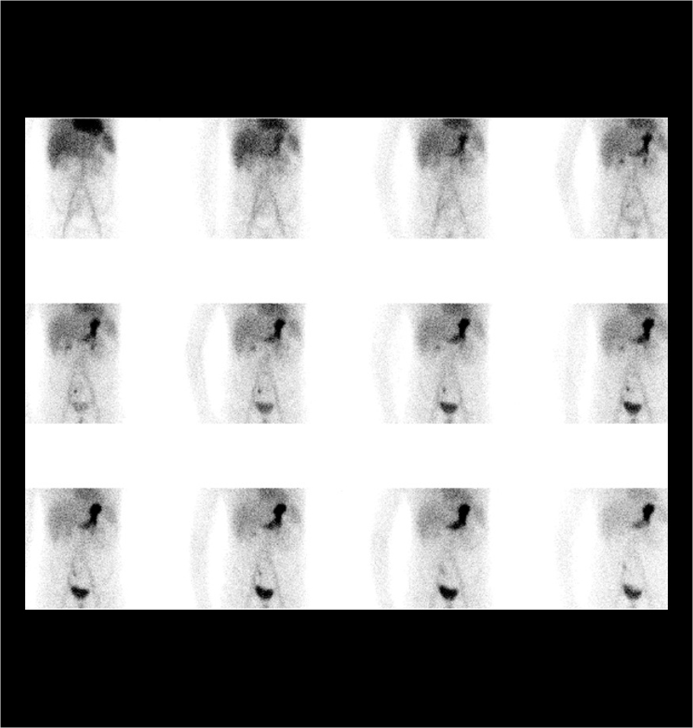 Scintigraphie du diverticule de Meckel