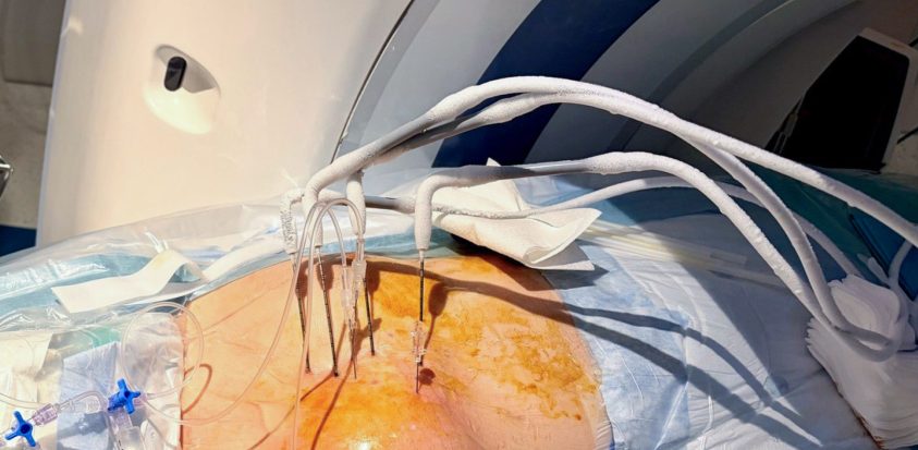 Cryothérapie dans le corps du patient
