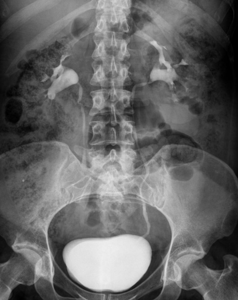 Cystographie