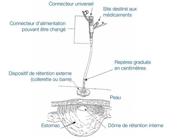 schéma explicatif d'une pose de GEP