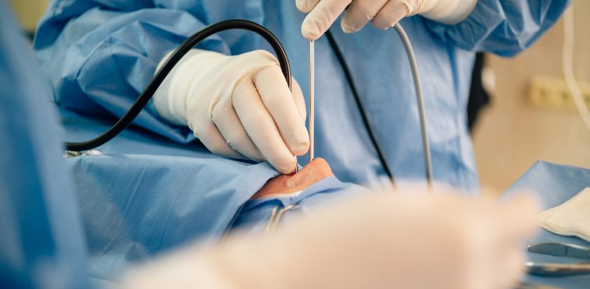 insertion d'un endoscope dans par le nez