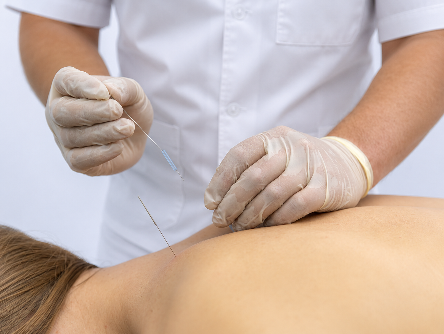 Pose d'aiguilles d'acupuncture
