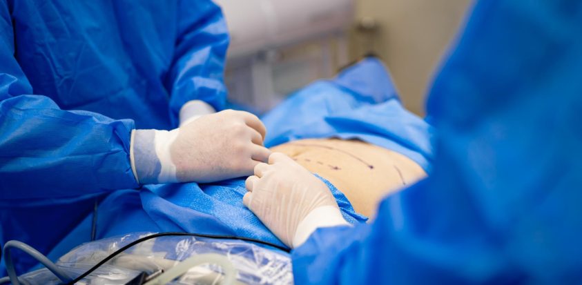 gastroplastie au bloc opératoire