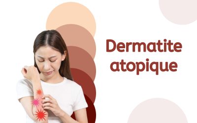 Stand d’information sur la dermatite atopique