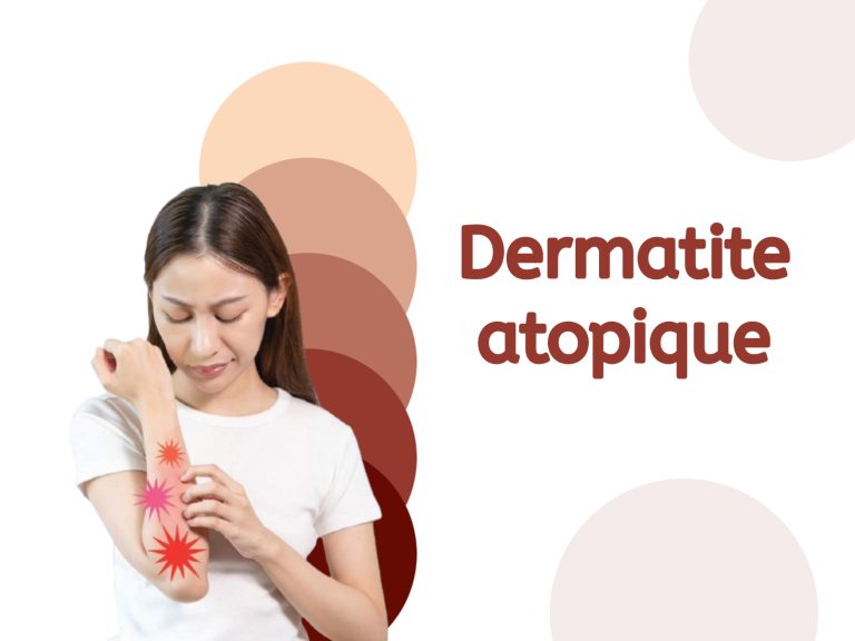 Stand d’information sur la dermatite atopique